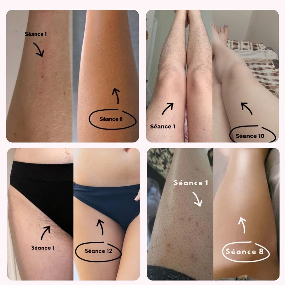 IPL Pulse • Épilateur à Lumière Pulsée